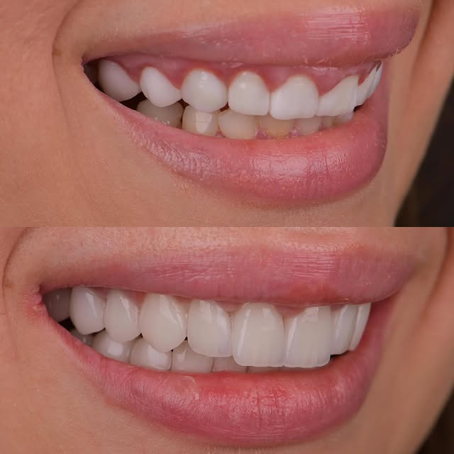 Dental Sirius restorasyon çalışması