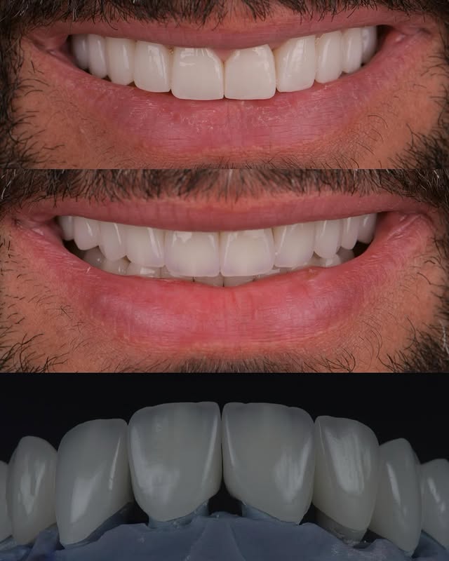 Titanyum Bar ve Custom Abutment