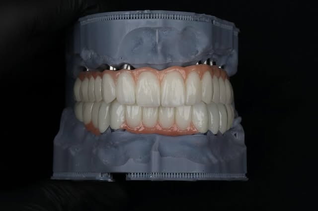 İmplant üstü dental restorasyon modeli